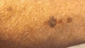 Tackling Senile Purpura: Skincare Strategies for Over 50s